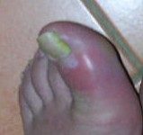 What Is ‘Covid Toe’? Maybe a strange sign of Coronavirus infection (NYT)